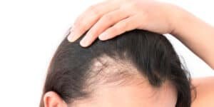 Read more about the article Can Weight Loss Cause Hair Loss