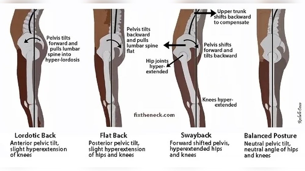 Can I Do Hyperextensions for Posture Correction?