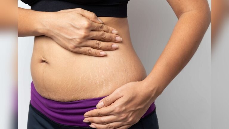 Can Weight Loss Cause Stretch Marks